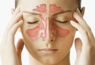 sinusitis