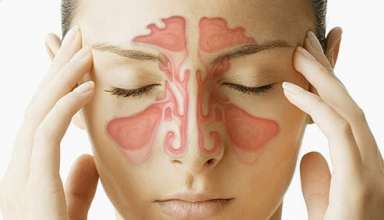 sinusitis