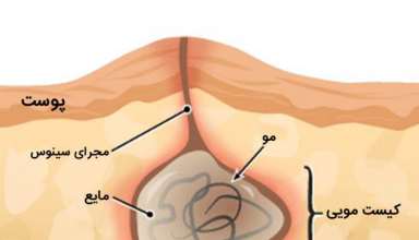 pilonidal-cyst